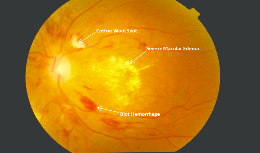 Severe nonproliferative diabetic retinopathy with severe ...