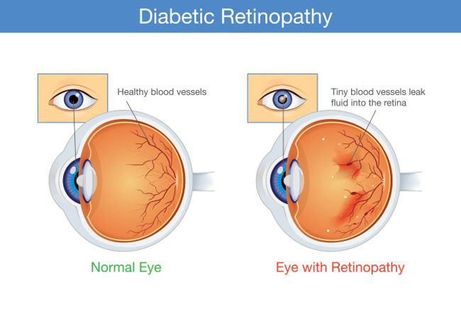 Signs, Causes, and Treatments of Diabetic Retinopathy