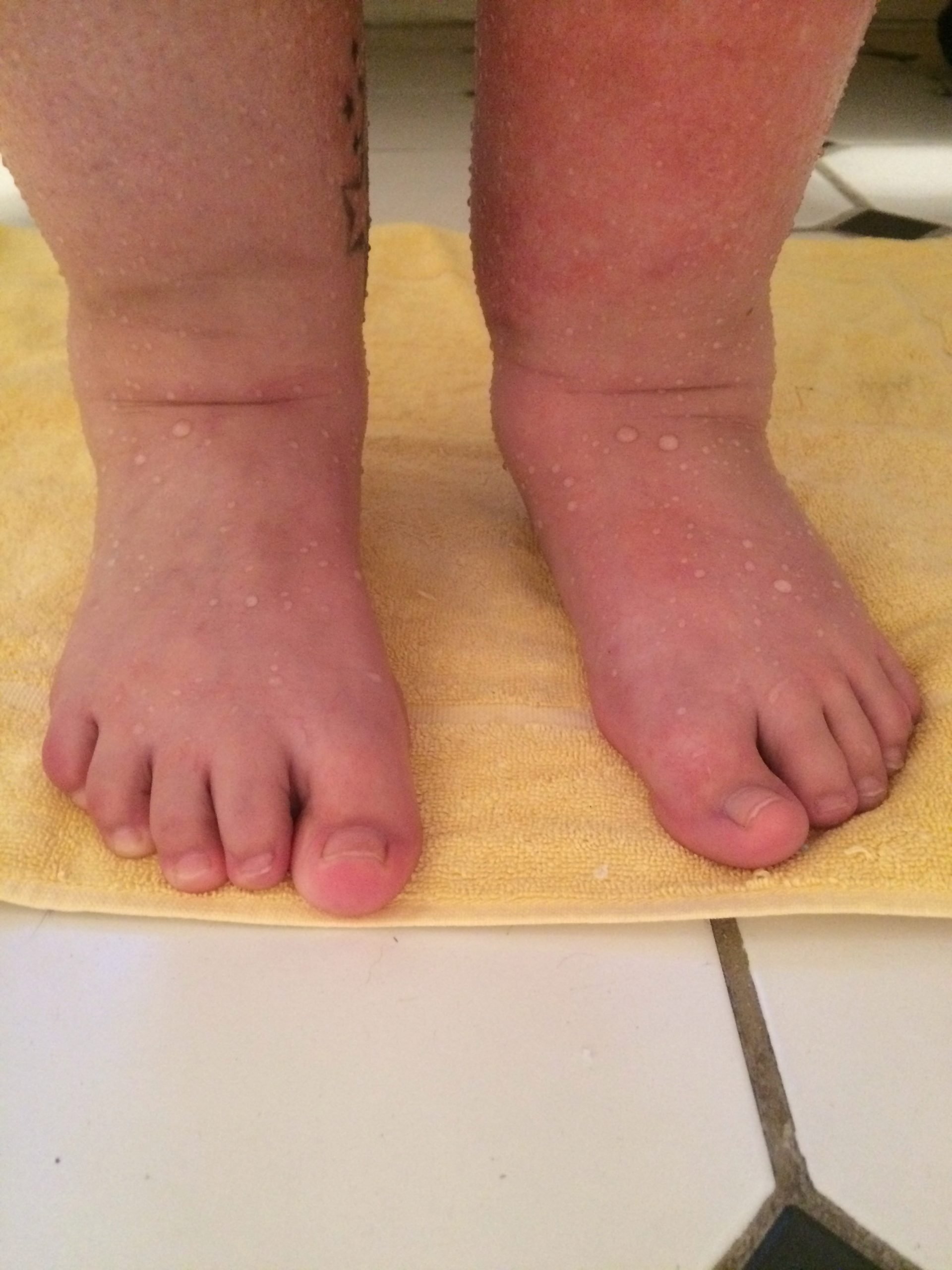 Swelling feet and legs  (  The Bump