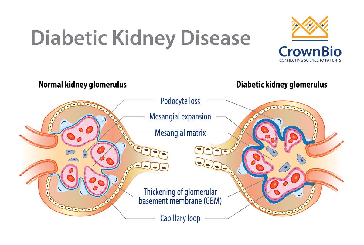 The Link Between Diabetes and Kidney Disease