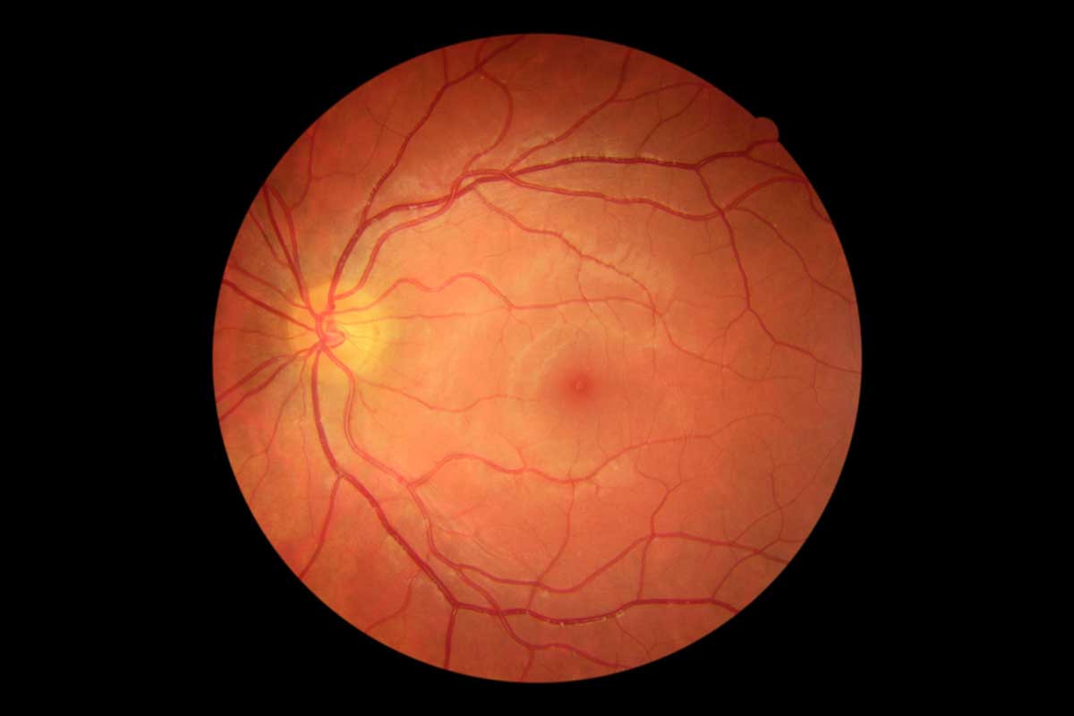 Things You Should Know About Diabetic Retinopathy