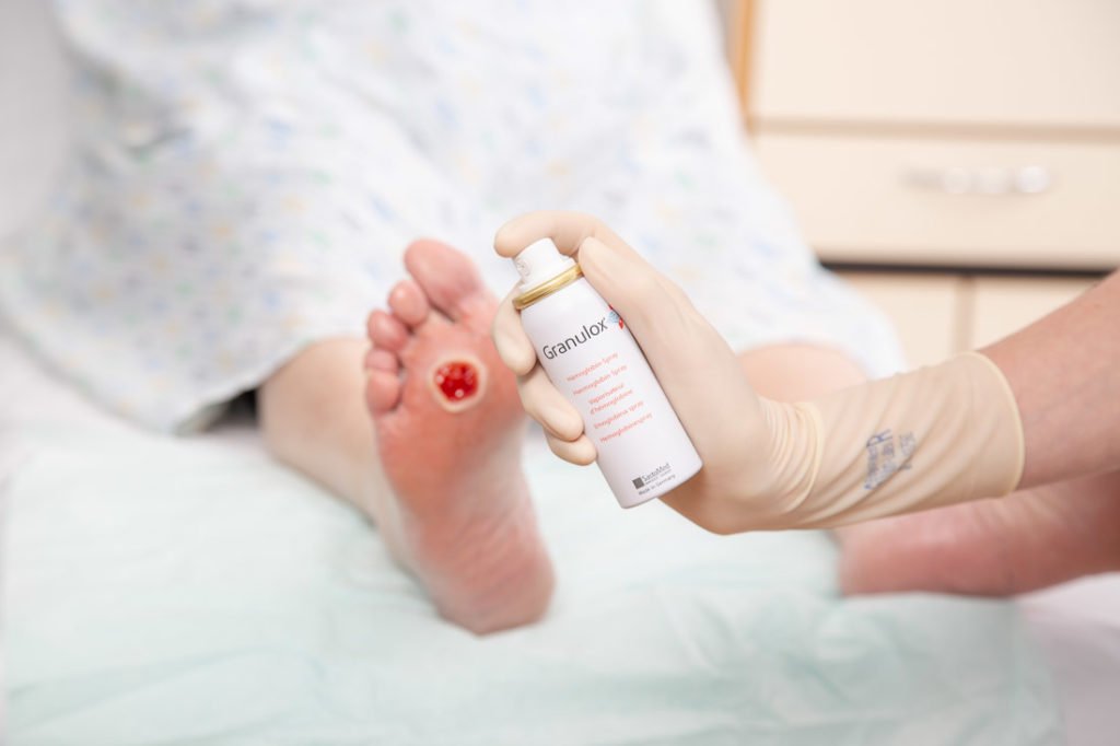 Thousands of diabetic foot ulcer patients could benefit ...