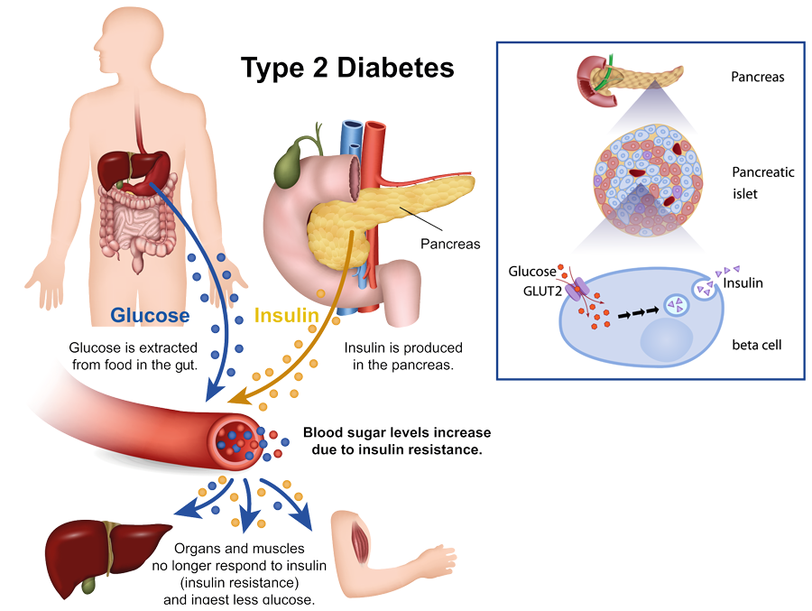 Timely insulin therapy to treat type 2 diabetes