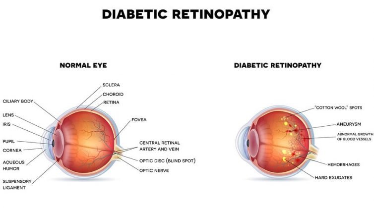 Treatment of Diabetic Retinopathy: Risks &  Prevention