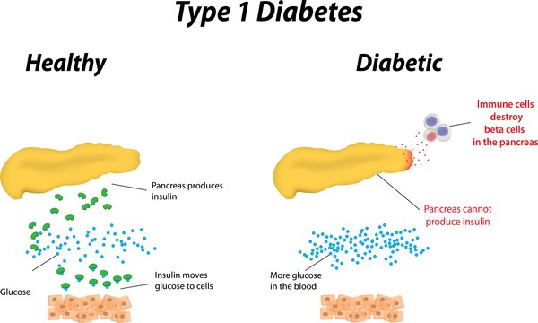 Type 1 diabetes: MedlinePlus Genetics
