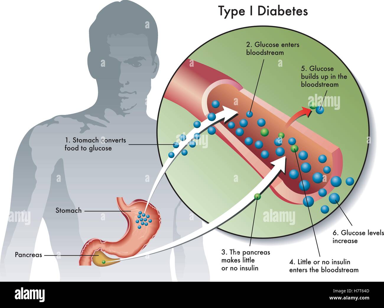 type 1 diabetes Stock Vector Art &  Illustration, Vector Image ...