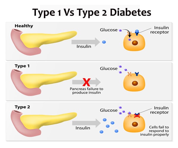 Type 1 vs type 2 Diabetes