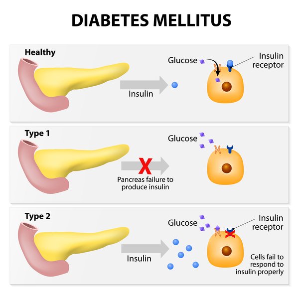 Type 2 diabetes: MedlinePlus Genetics
