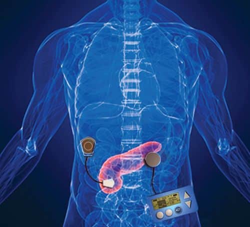 Type 2 Diabetes Remission Can Restore the Pancreas