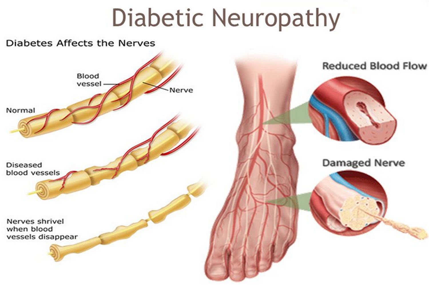 Type 2 Diabetic Patients Can Suffer Serious Nerve Damage By Reduced ...