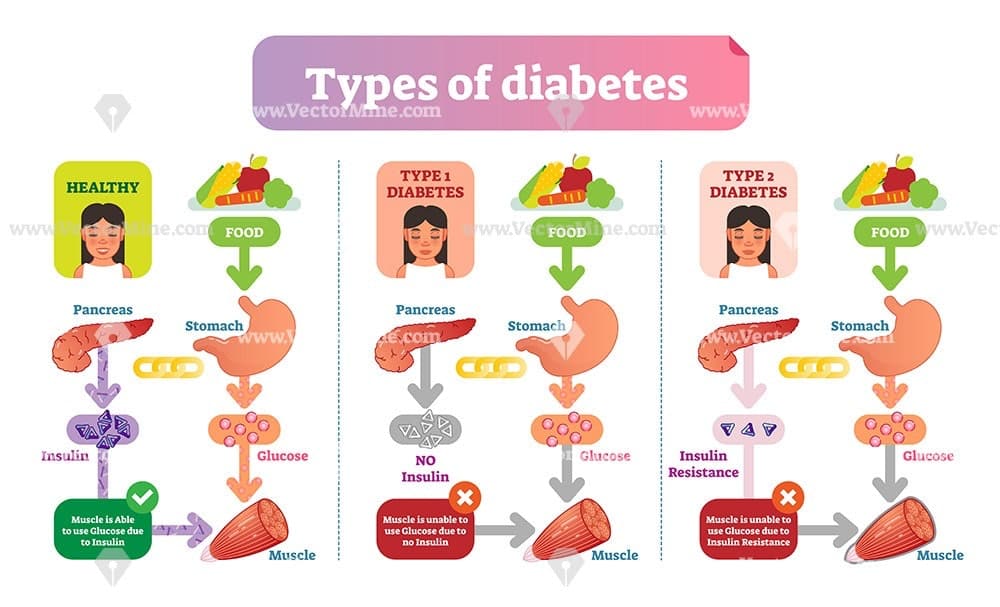 Types of diabetes vector illustration diagram
