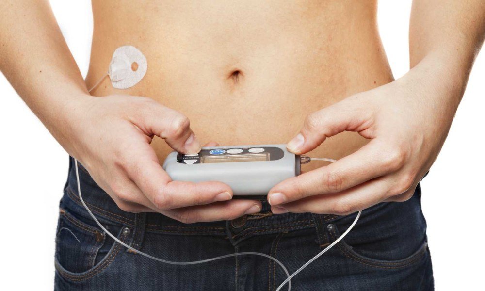United States Insulin Pump Market Size, Analysis and Forecast ...