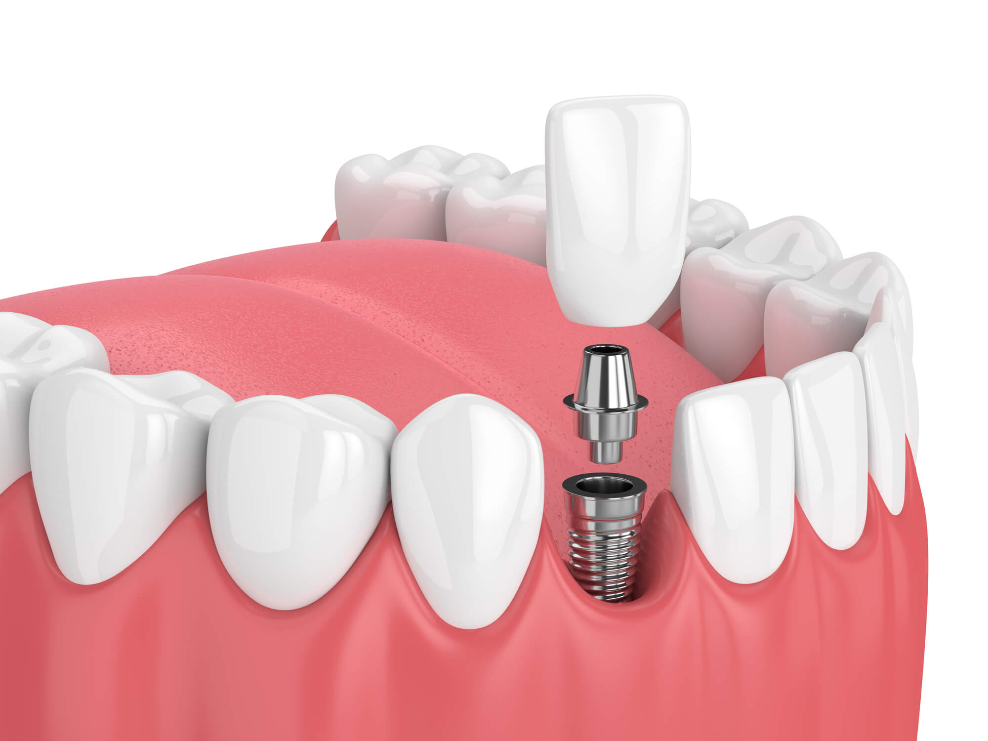 What Happens Before, During, and After a Dental Implant ...