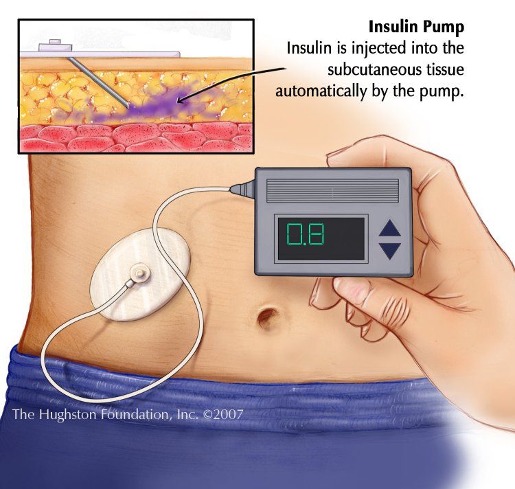 What Is The Best Insulin Pump For Type 1 Diabetes