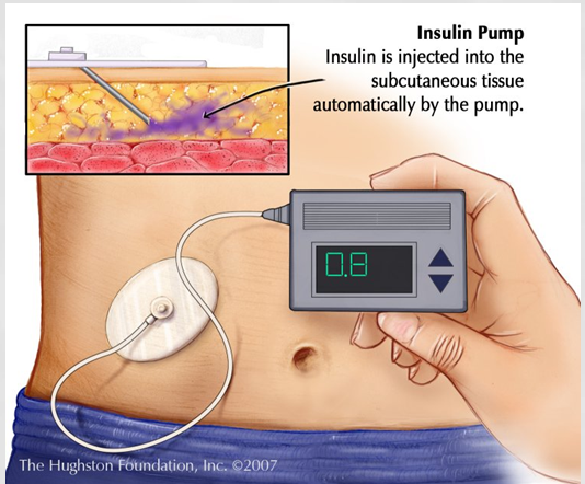 When I see a diabetic with an insulin pump, where do all ...