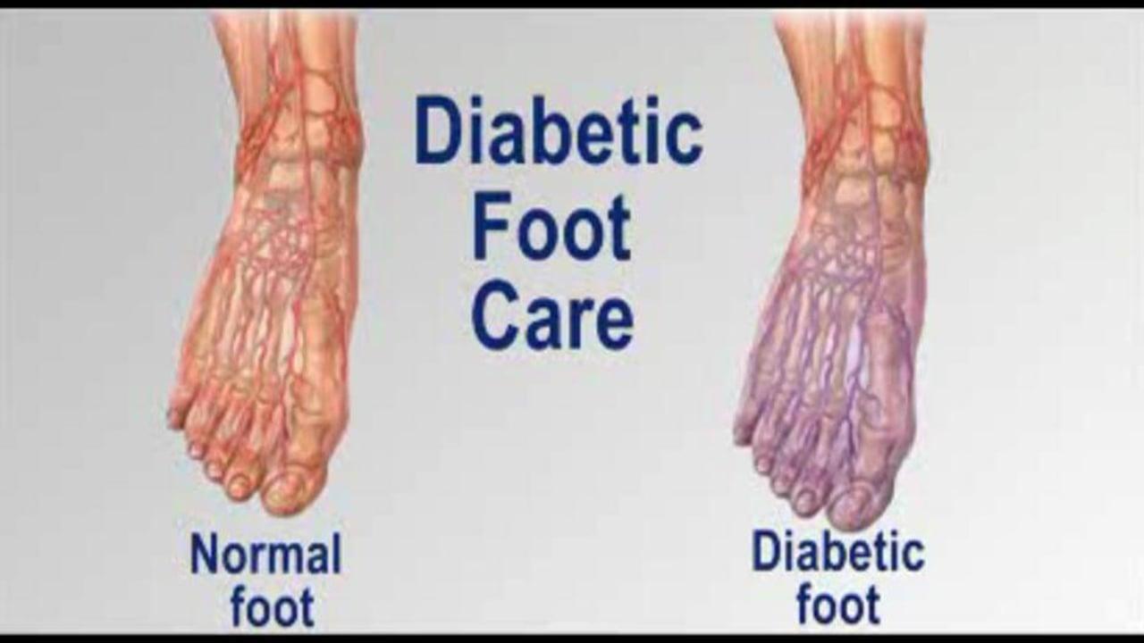 Why Do People With Diabetes Lose Their Legs ...
