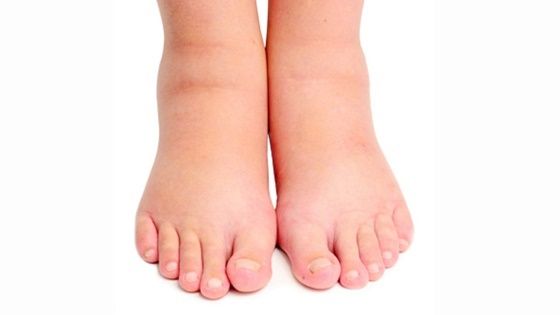 Why does a person with type 2 diabetes feet swell?